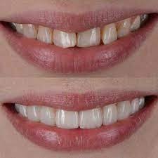 Teeth Whitening Aberdeen