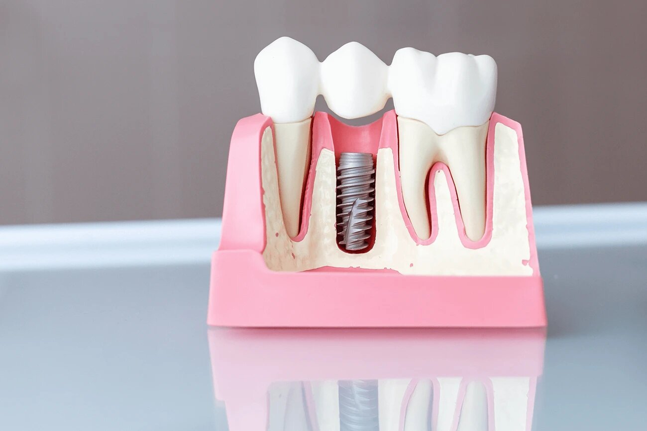 Dental Implants in Kingman