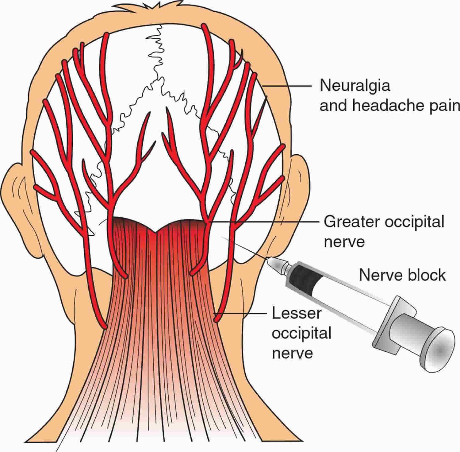 Occipital Nerve Block