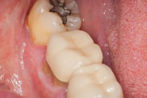 treatment of tooth abscess