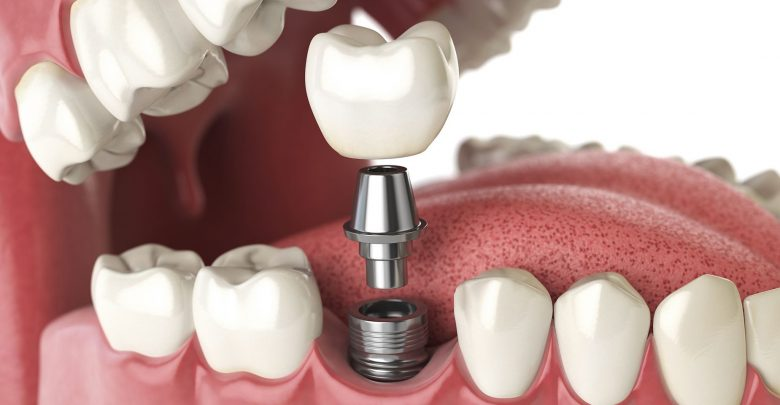 dental implants singapore