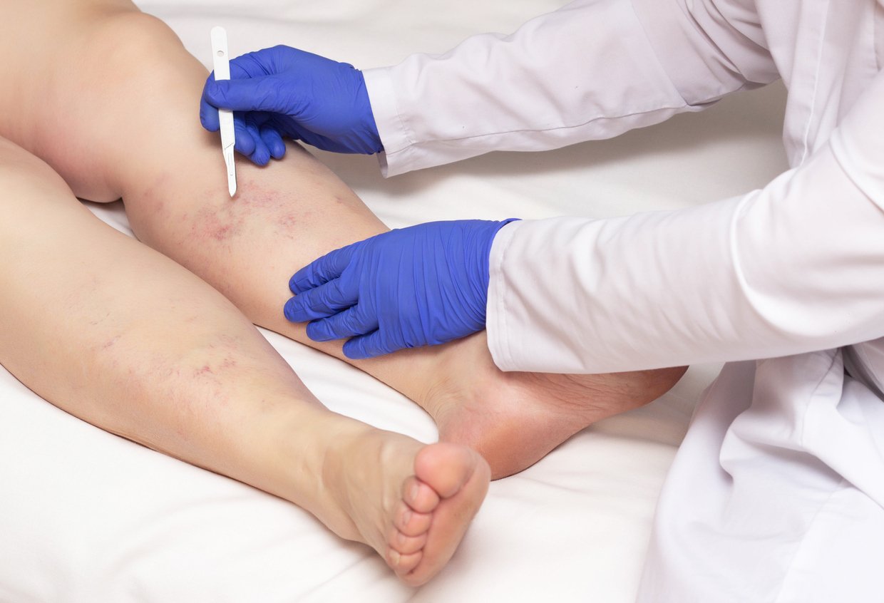 varicose vein specialist called