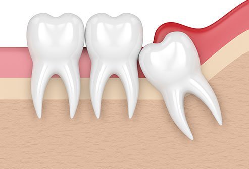 Dental Implant